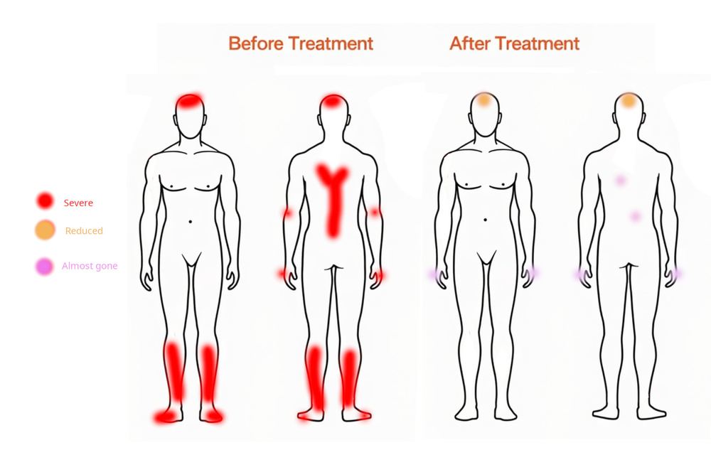 Two hand-drawn body outlines comparing where Swarna's skin itched before and after her sessions